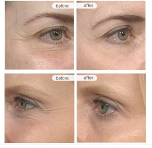 Glycation before and after of fine lines and wrinkles